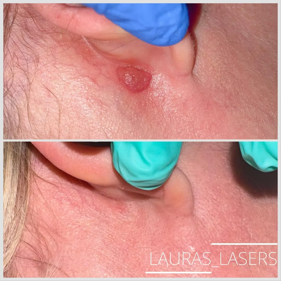 Mole and lesion removal before and after, ear area, Calgary
