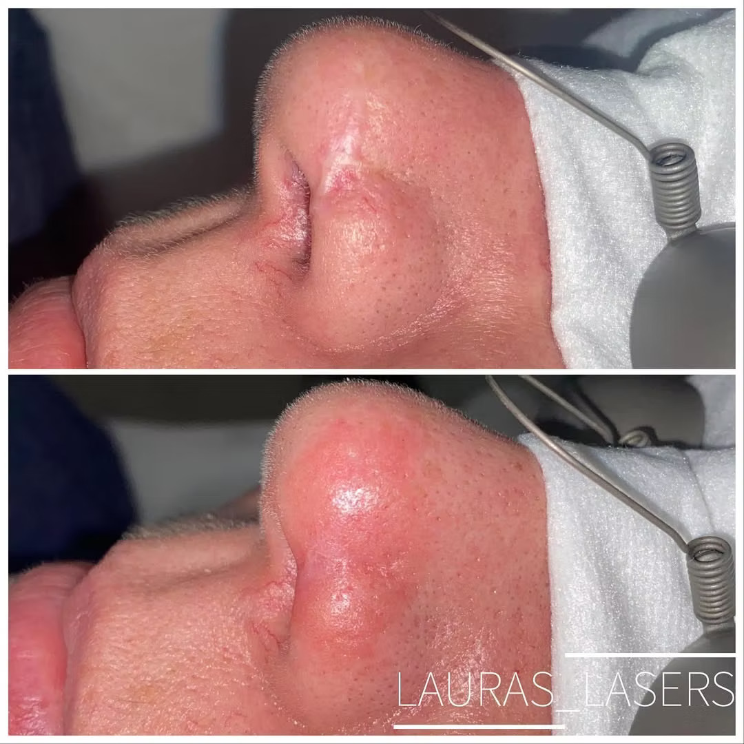 Laser scar revision before and after, nose, Calgary