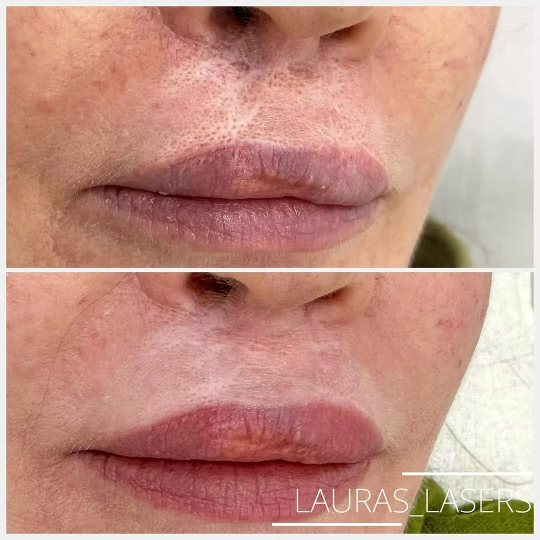 Laser scar revision before and after, lip, Calgary