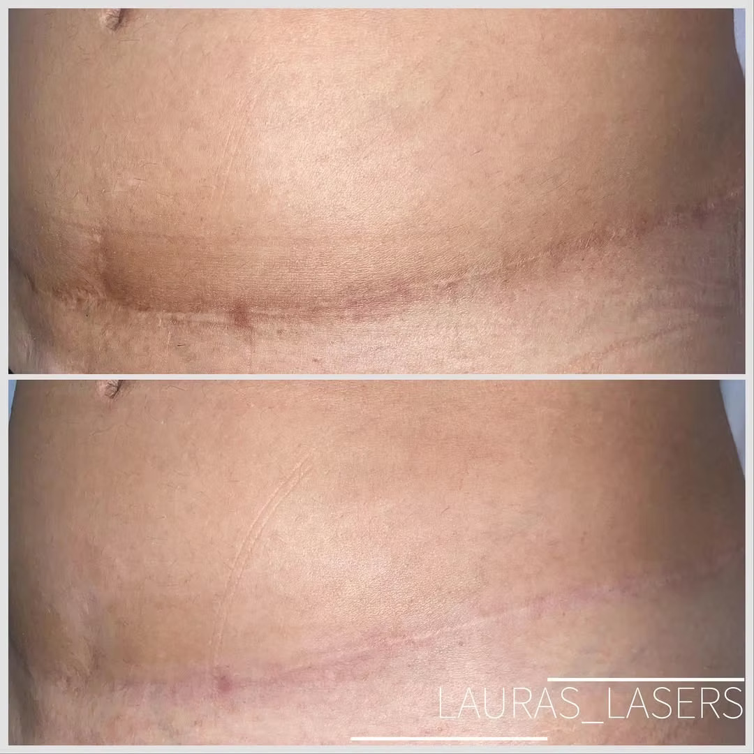 Laser scar revision before and after, abdomen, Calgary