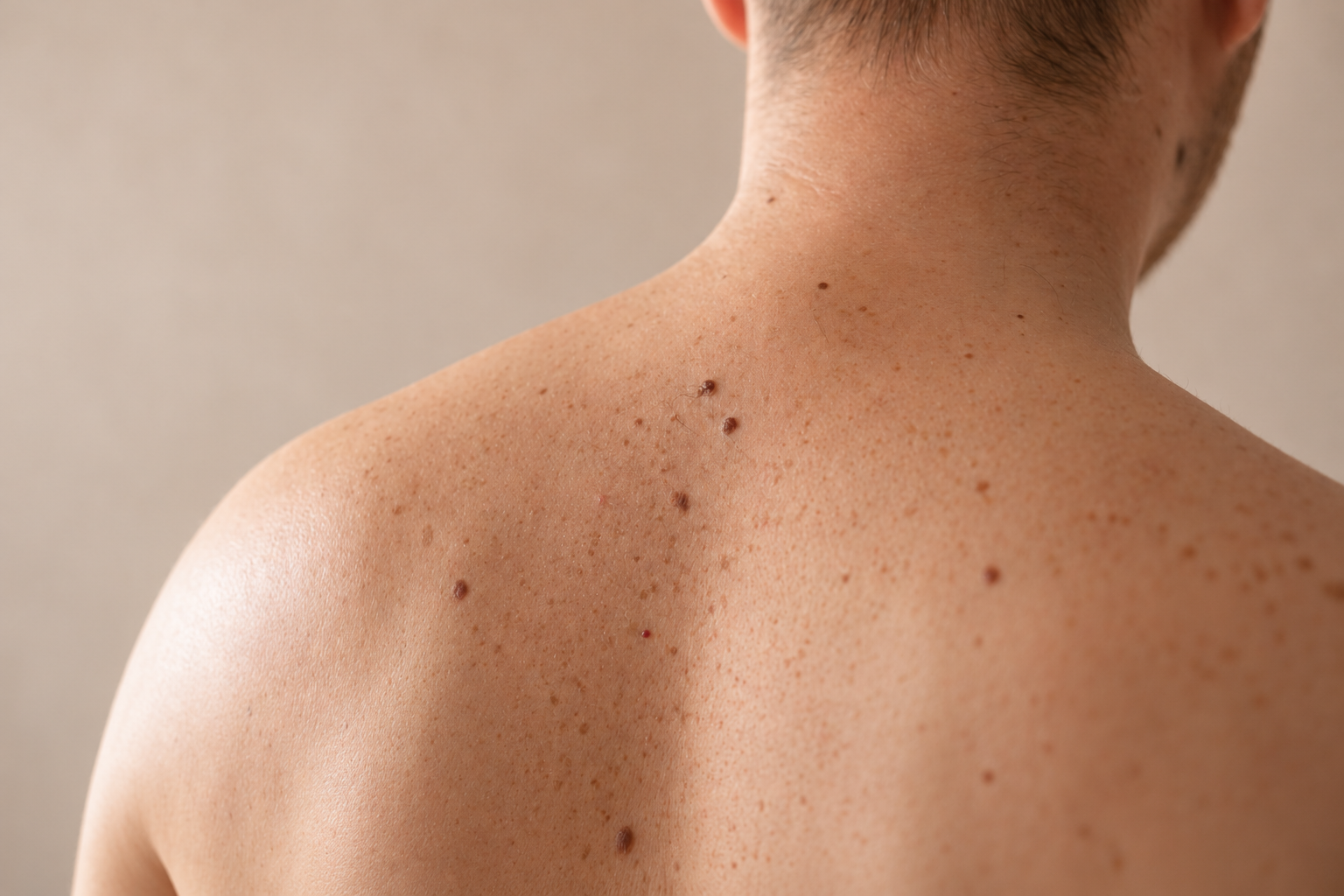 Mole & Lesion Removal in Calgary