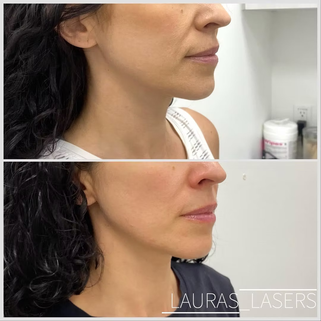 Skin tightening before and after, jawline, Calgary