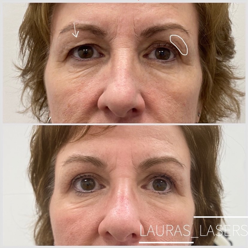 Laser blepharoplasty before and after, brow and eye area, Calgary