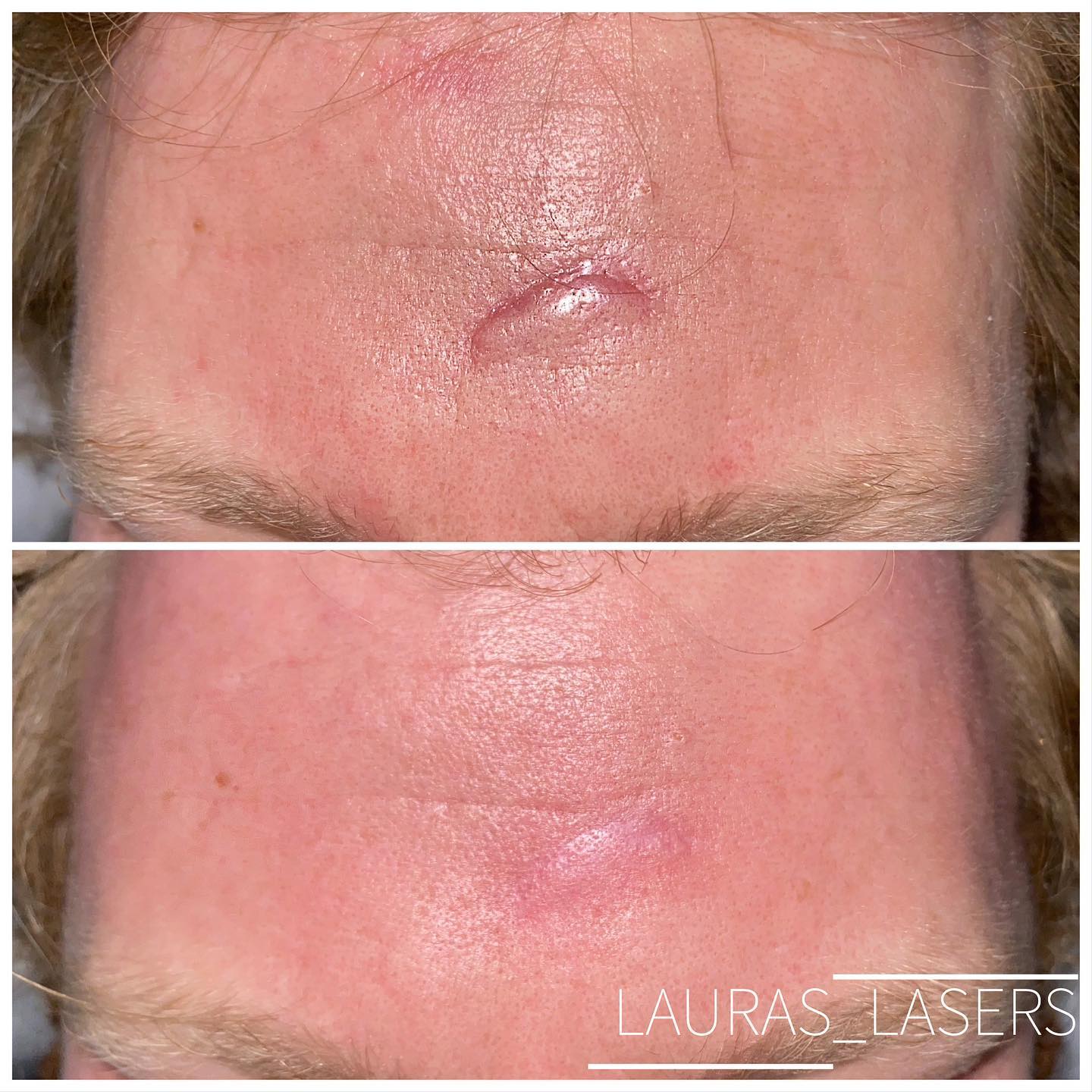 Laser scar revision before and after, forehead, Calgary