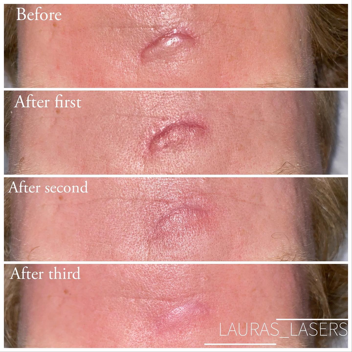 Laser scar revision healing progression over three treatments, forehead, Calgary