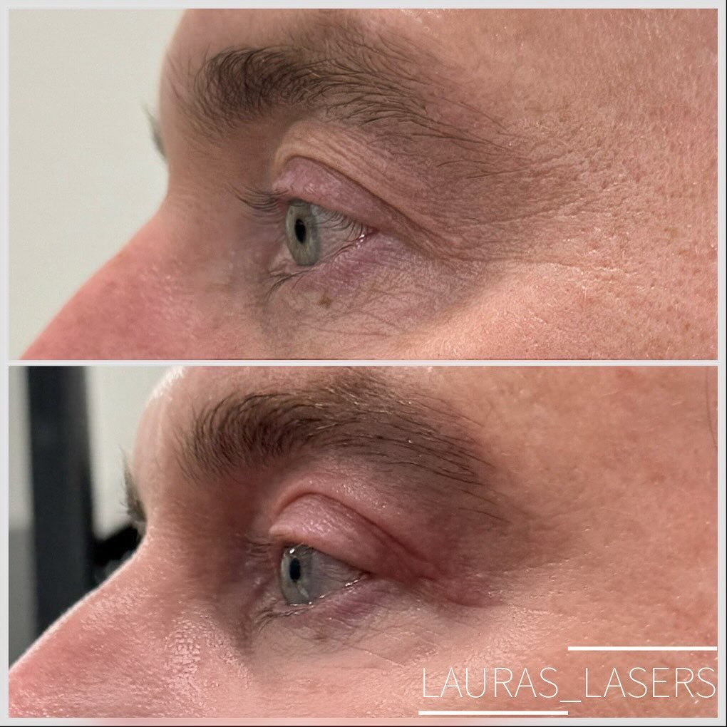 Laser blepharoplasty before and after, upper eyelid, male patient, Calgary