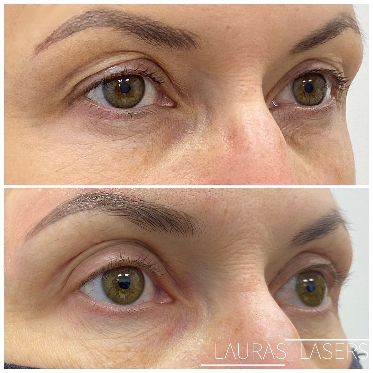 Laser blepharoplasty before and after, upper eyelids, Calgary