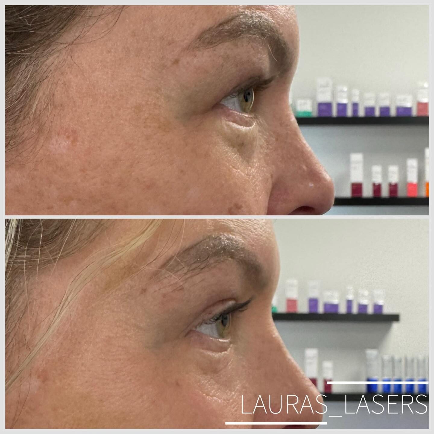 Laser blepharoplasty before and after, cheek and eye area, Calgary