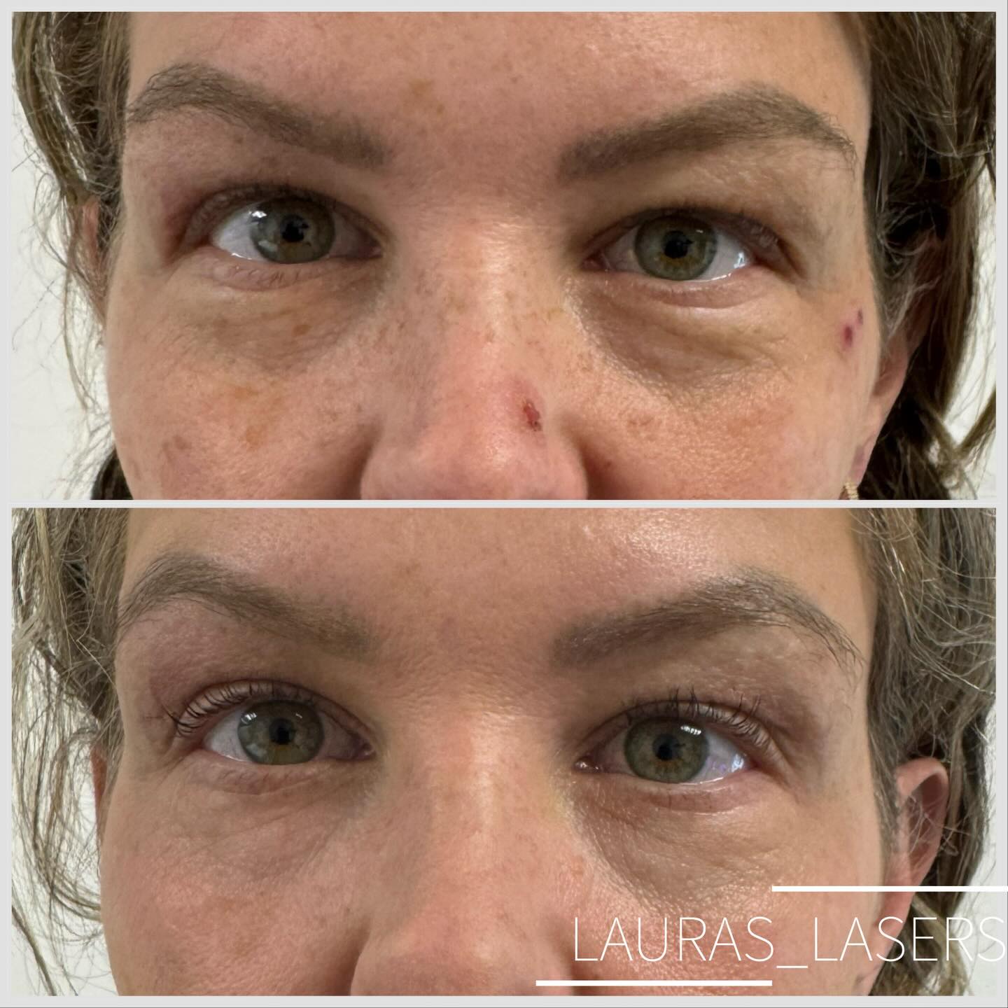Laser blepharoplasty before and after, eye area, Calgary
