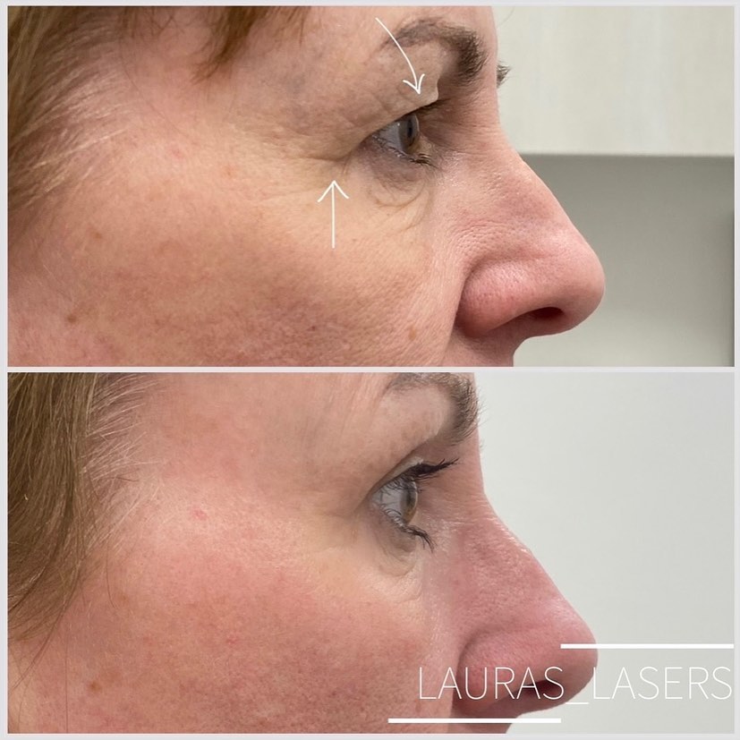Laser blepharoplasty before and after, lower eyelid and cheek, Calgary
