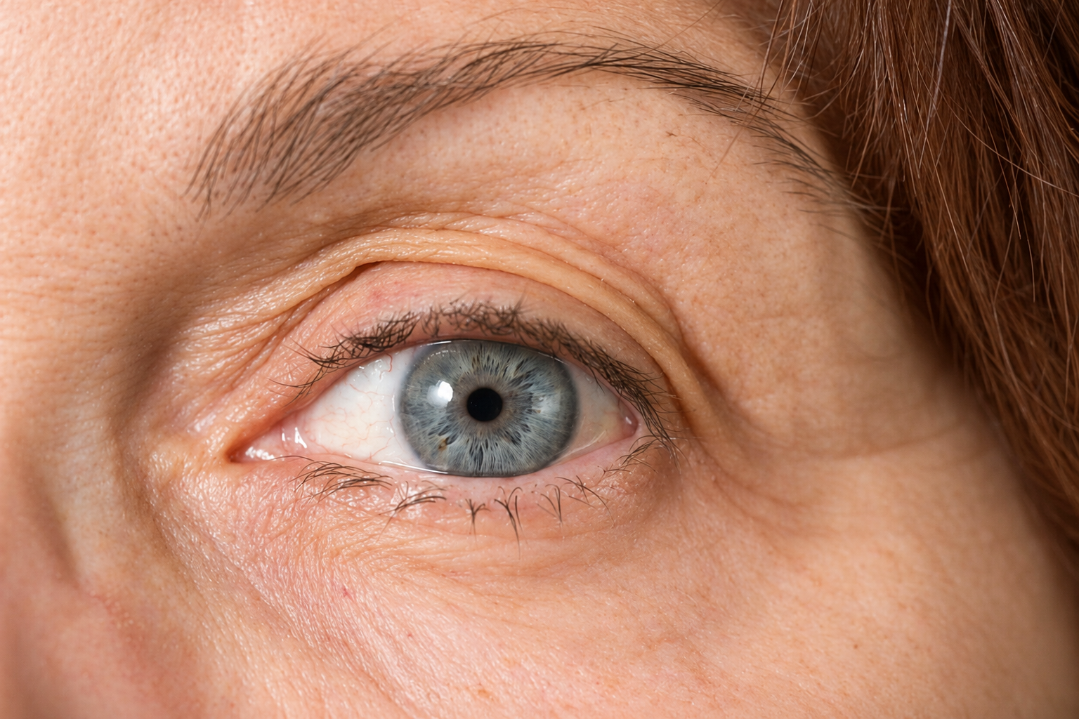 Laser Blepharoplasty in Calgary